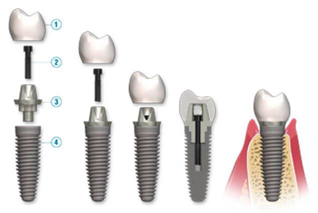 Implantes dentales